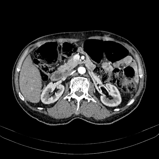 Abdominal aortic aneurysm (Radiopaedia 83581-98689 Axial C+ arterial phase 49).jpg