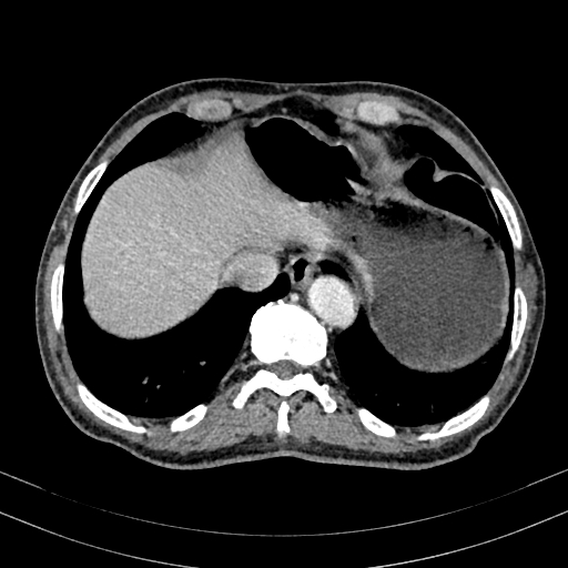 File:Abdominal aortic aneurysm (Radiopaedia 83581-98689 Axial C+ portal venous phase 13).jpg