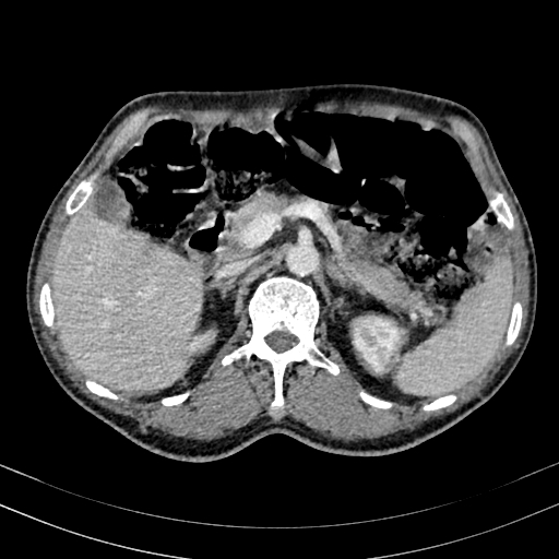 Abdominal aortic aneurysm (Radiopaedia 83581-98689 Axial C+ portal venous phase 36).jpg