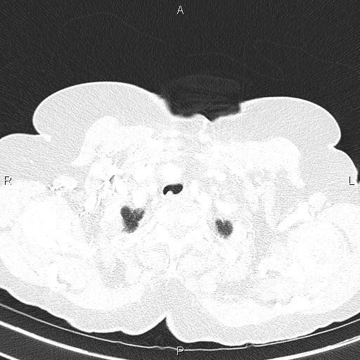 Abdominal aortic aneurysm (Radiopaedia 85063-100606 Axial lung window 11).jpg