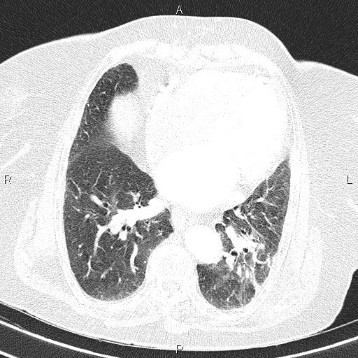 Abdominal aortic aneurysm (Radiopaedia 85063-100606 Axial lung window 43).jpg