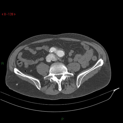 Abdominal aortic aneurysm rupture with aortocaval fistula (Radiopaedia 14897-14841 Axial C+ arterial phase 139).jpg