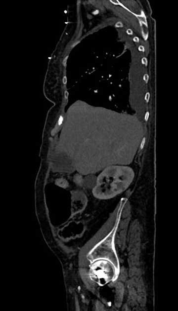 Abdominal aortic aneurysm with thrombus fissuration (Radiopaedia 73192-83919 Sagittal C+ arterial phase 112).jpg