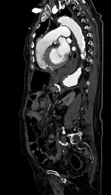 Abdominal aortic aneurysm with thrombus fissuration (Radiopaedia 73192-83919 Sagittal C+ arterial phase 52).jpg
