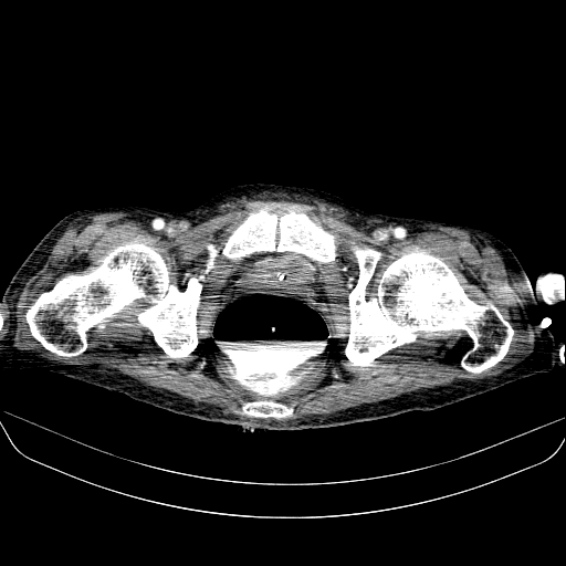 File:Abdominal collection due to previous cecal perforation (Radiopaedia 80831-94320 Axial C+ portal venous phase 204).jpg