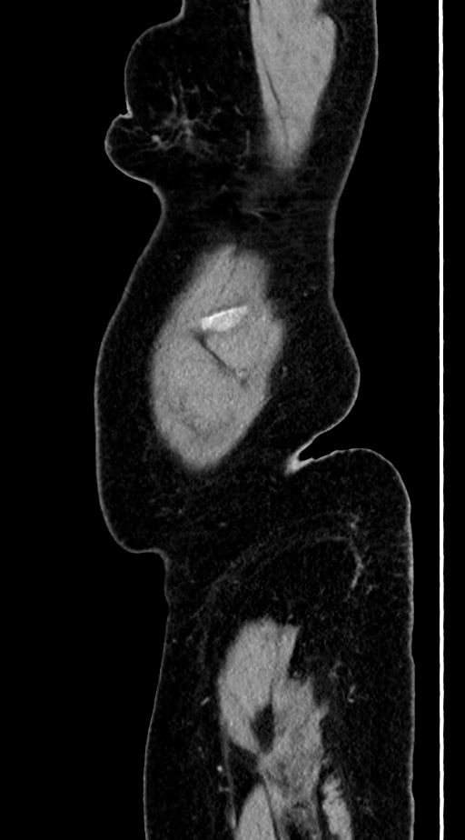 Abdominal hydatid disease (Radiopaedia 68223-77737 Sagittal C+ portal venous phase 71).jpg