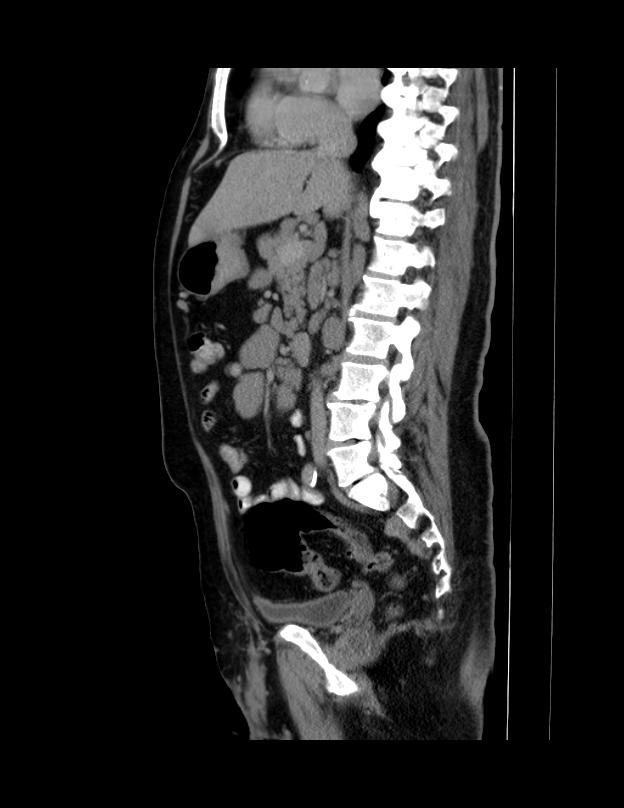 Abdominal lymphoma - with sandwich sign (Radiopaedia 53486-59492 Sagittal C+ portal venous phase 43).jpg