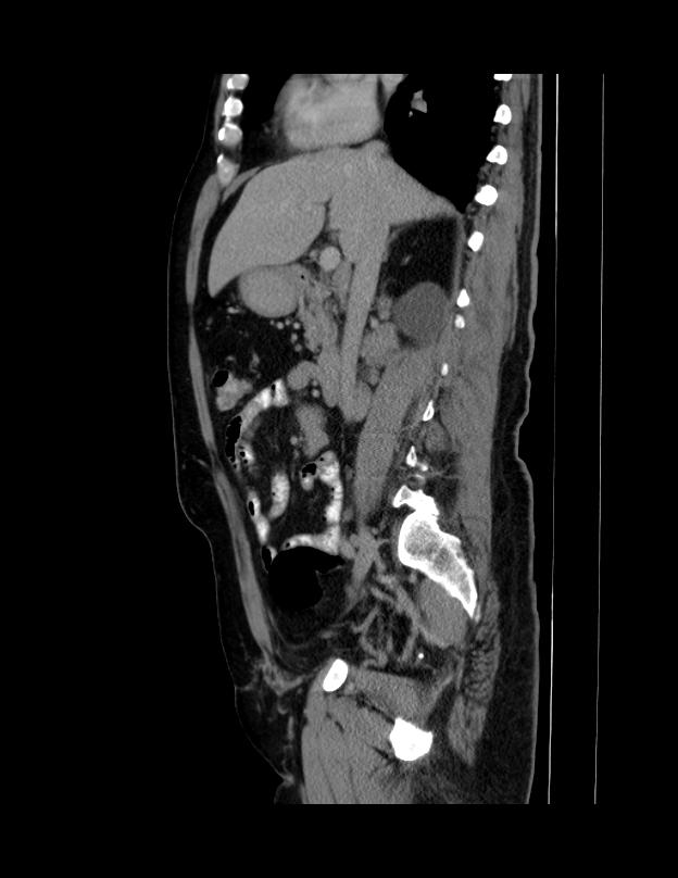 Abdominal lymphoma - with sandwich sign (Radiopaedia 53486-59492 Sagittal C+ portal venous phase 48).jpg