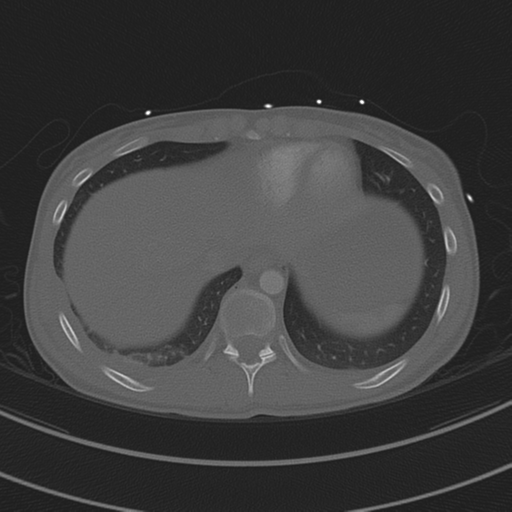 File:Abdominal multi-trauma - devascularised kidney and liver, spleen and pancreatic lacerations (Radiopaedia 34984-36486 I 69).png