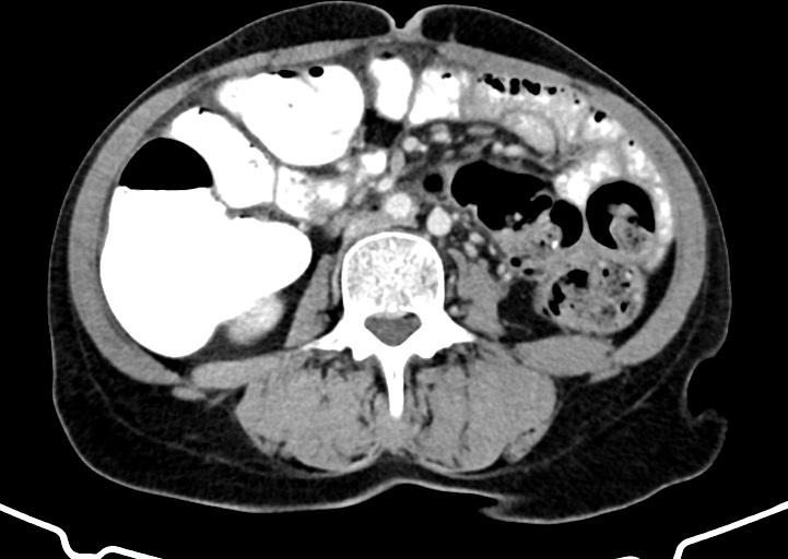 Abdominal wall and retroperitoneal tuberculosis (Radiopaedia 88137-104729 Axial C+ portal venous phase 104).jpg