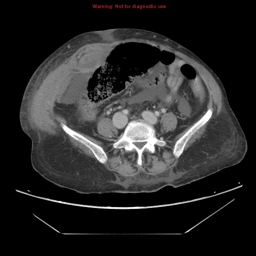 File:Abdominal wall hematoma (Radiopaedia 9427-10112 Axial C+ portal venous phase 71).jpg