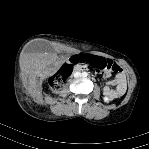 Abdominal wall hematoma with active bleeding (Radiopaedia 83915-99117 Axial C+ portal venous phase 48).jpg