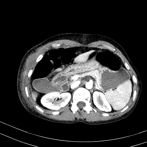 Abdominal wall hematoma with active bleeding (Radiopaedia 83915-99117 Axial renal cortical phase 8).jpg