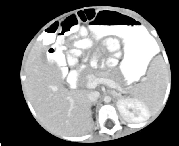 Abdominopelvic rhabdomyosarcoma (Radiopaedia 78356-90984 Axial C+ portal venous phase 60).jpg