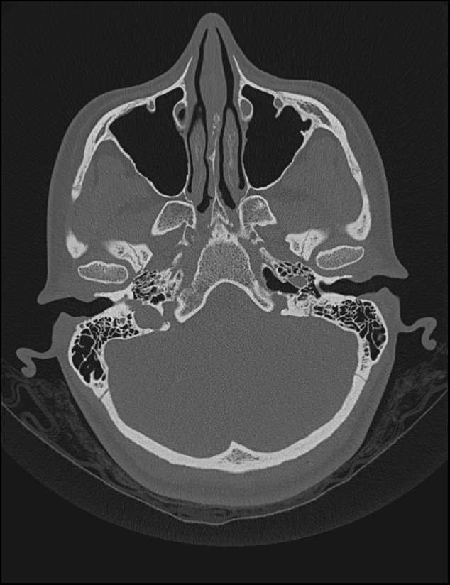 Aberrant right internal carotid artery (Radiopaedia 65191-74198 Axial non-contrast 32).jpg