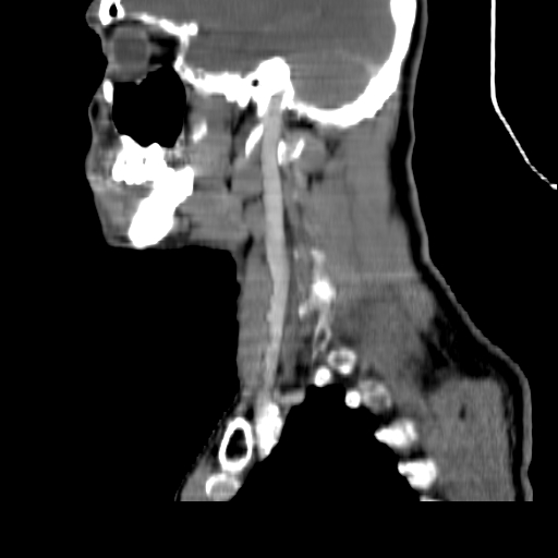 File:Aberrant right subclavian artery (Radiopaedia 26364-26497 Sagittal C+ arterial phase 18).jpg