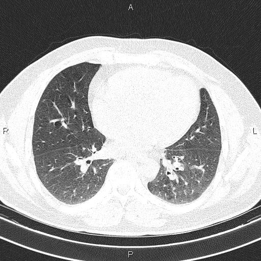 File:Aberrant right subclavian artery (Radiopaedia 87093-103354 Axial lung window 69).jpg