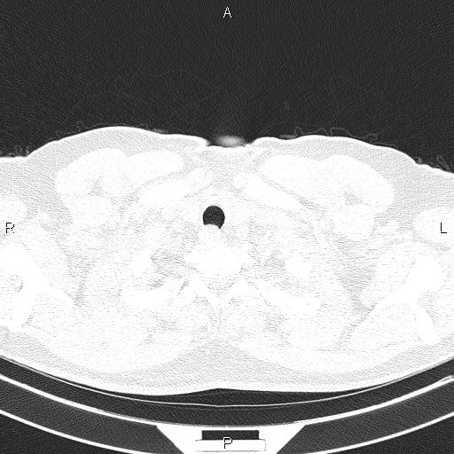 File:Aberrant right subclavian artery (Radiopaedia 87093-103354 Axial lung window 7).jpg