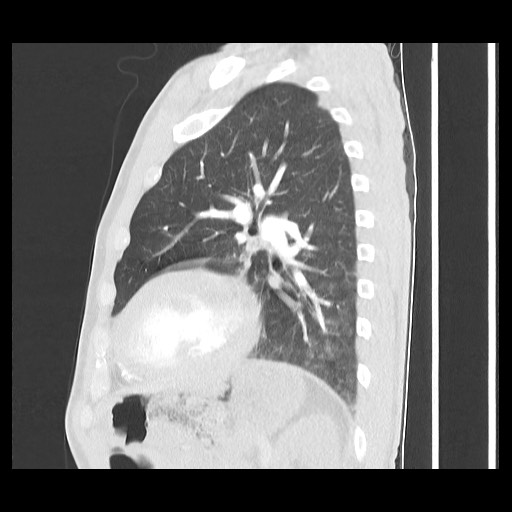 Accessory left horizontal fissure with lingular pneumonia (Radiopaedia 53763-59843 Sagittal lung window 47).jpg