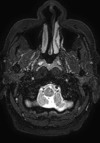 File:Accessory middle cerebral artery (Radiopaedia 73114-83828 Axial T2 218).jpg