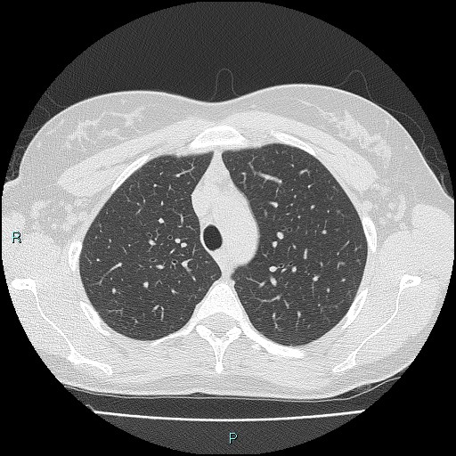 Accidental foreign body aspiration (seamstress needle) (Radiopaedia 77740-89983 Axial lung window 18).jpg