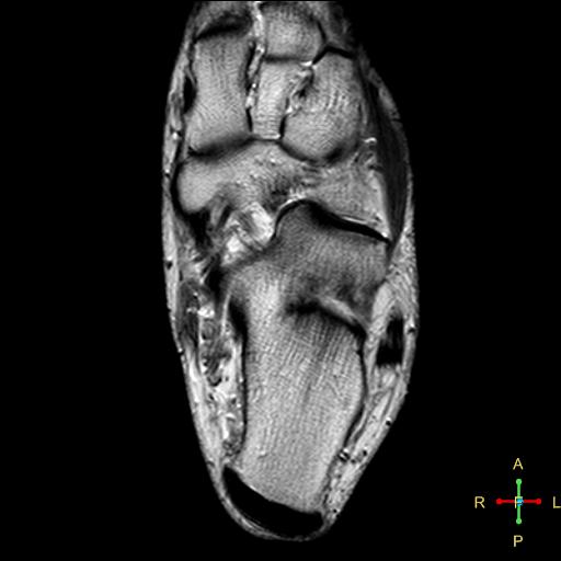 File:Achilles tendon complete tear (Radiopaedia 22834-22854 Axial T2 2).jpg