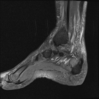 File:Achilles tendon tear (Radiopaedia 77615-89819 Sagittal PD fat sat 6).jpg