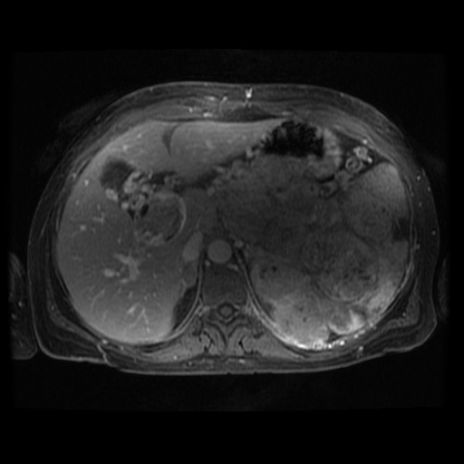 Acinar cell carcinoma of the pancreas (Radiopaedia 75442-86668 Axial T1 C+ fat sat 89).jpg