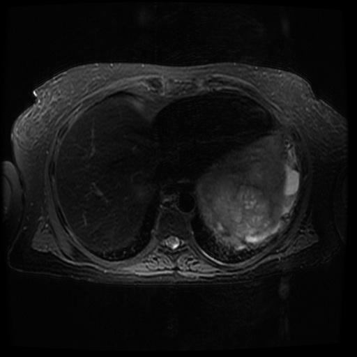 Acinar cell carcinoma of the pancreas (Radiopaedia 75442-86668 Axial T2 fat sat 12).jpg