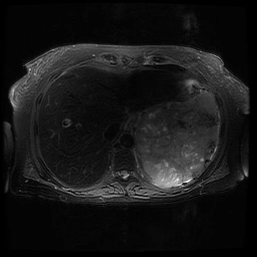 Acinar cell carcinoma of the pancreas (Radiopaedia 75442-86668 Axial T2 fat sat 16).jpg