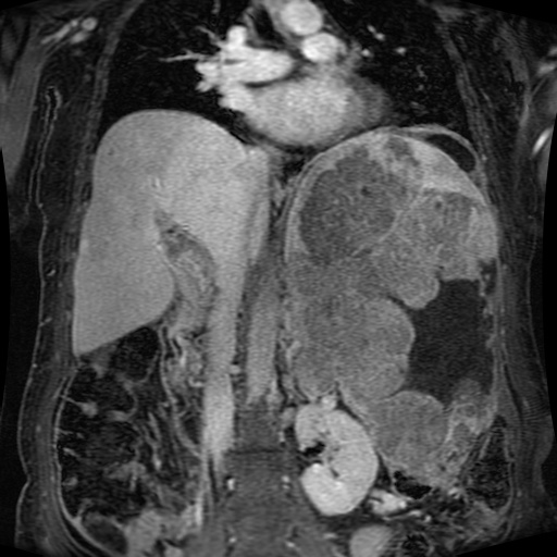 Acinar cell carcinoma of the pancreas (Radiopaedia 75442-86668 Coronal T1 C+ fat sat 94).jpg