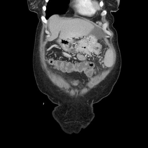 Acinar cell carcinoma of the pancreas (Radiopaedia 75442-86669 Coronal C+ portal venous phase 23).jpg