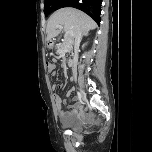 Acinar cell carcinoma of the pancreas (Radiopaedia 75442-86669 Sagittal C+ portal venous phase 82).jpg