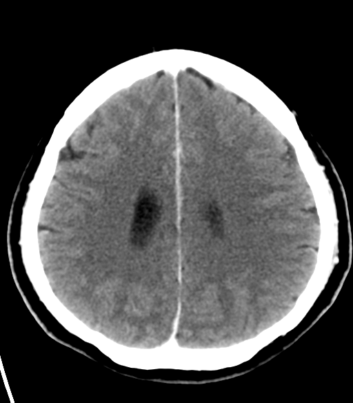 File:Acoustic schwannoma (Radiopaedia 33045-34065 Axial C+ delayed 19).png