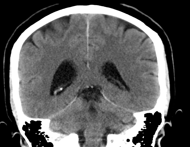 File:Acoustic schwannoma (Radiopaedia 33045-34065 Coronal non-contrast 29).png