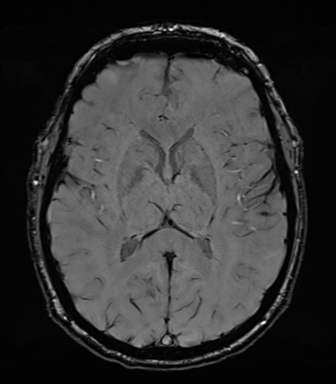 Acoustic schwannoma (Radiopaedia 50846-56358 Axial SWI 51).png