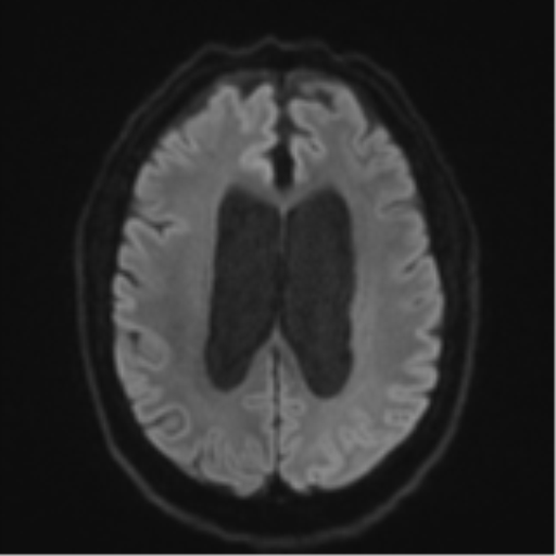 Acoustic schwannoma (Radiopaedia 55729-62281 E 45).png
