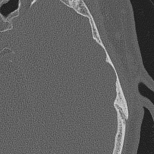 Acoustic schwannoma - cystic (Radiopaedia 29487-29980 AXIAL LEFT bone window 53).jpg