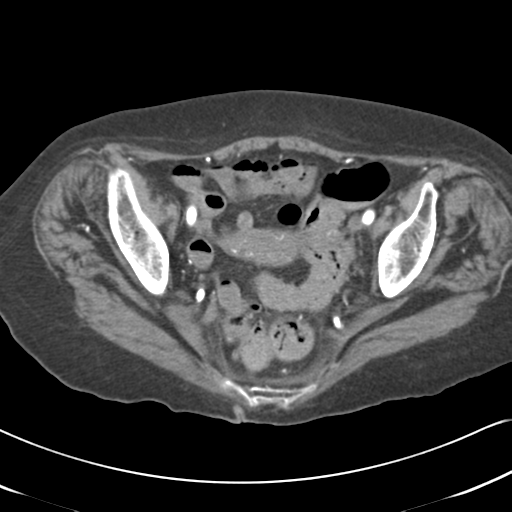 Active bleeding from duodenal ulcer with embolization (Radiopaedia 34216-35481 Axial C+ arterial phase 56).png