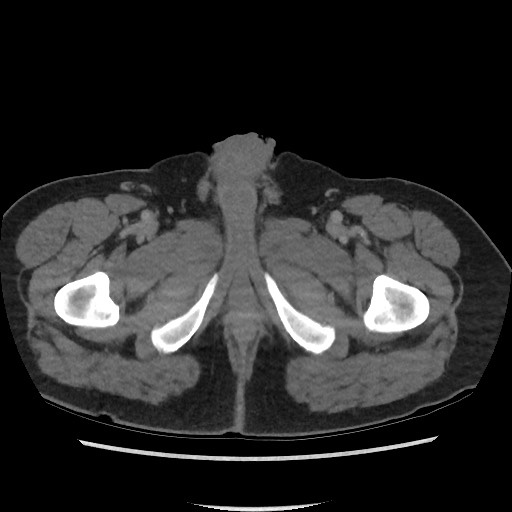 File:Active colonic bleed on CT (Radiopaedia 49765-55025 Axial C+ delayed 90).jpg