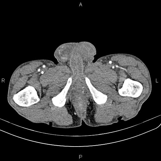 Active crohn disease (Radiopaedia 87133-103397 Axial C+ arterial phase 111).jpg
