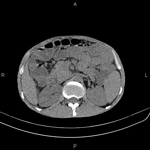 File:Active crohn disease (Radiopaedia 87133-103397 Axial non-contrast 36).jpg