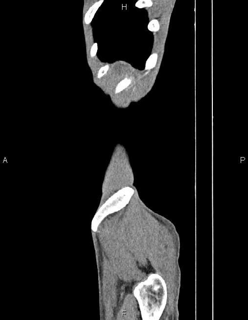 Active crohn disease (Radiopaedia 87133-103397 Sagittal C+ arterial phase 2).jpg