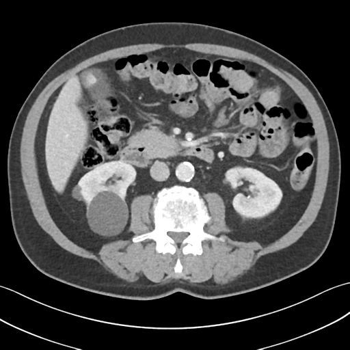 File:Active diverticular hemorrhage (Radiopaedia 39415-41725 Axial C+ portal venous phase 29).png