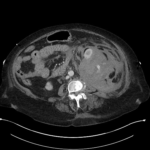 File:Active renal extravasation with large subcapsular and retroperitoneal hemorrhage (Radiopaedia 60975-68796 Axial 239).jpg