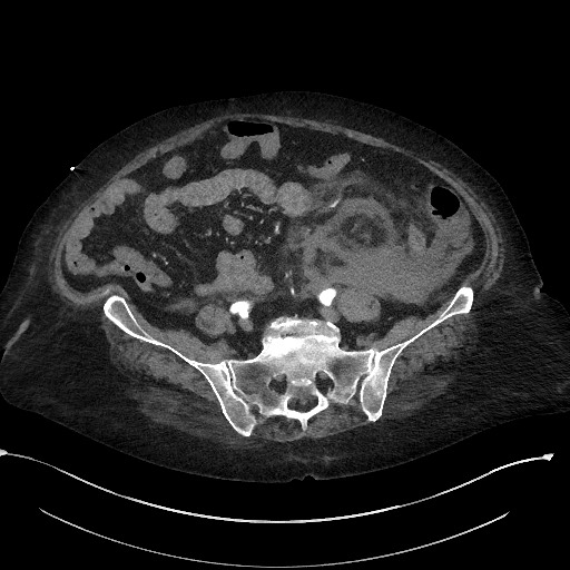 Active renal extravasation with large subcapsular and retroperitoneal hemorrhage (Radiopaedia 60975-68796 Axial C+ arterial phase 135).jpg