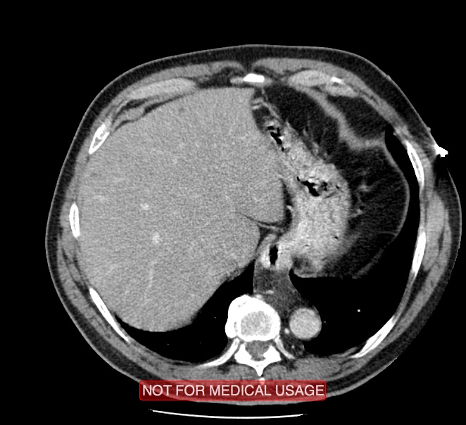 Acute aortic dissection - Stanford type A (Radiopaedia 40661-43285 Axial C+ portal venous phase 57).jpg