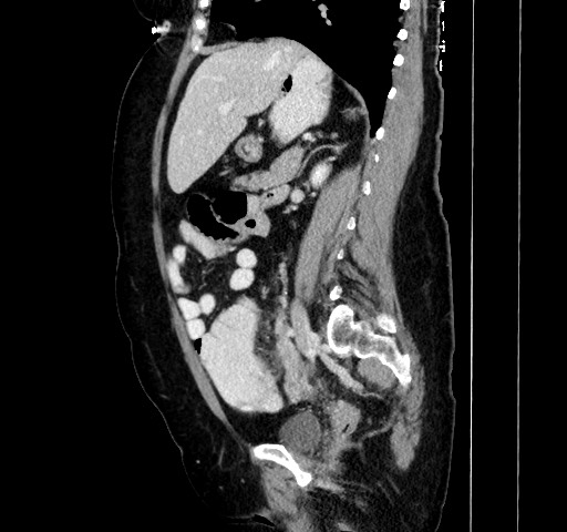 File:Acute appendicitis, heterotaxy syndrome (Radiopaedia 66884-76202 Sagittal C+ portal venous phase 58).jpg