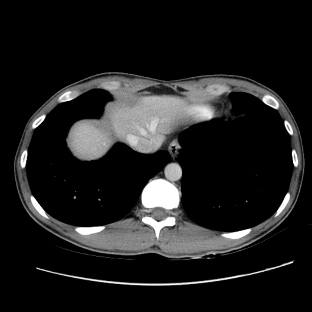 Acute appendicitis (Radiopaedia 27049-27227 Axial C+ portal venous phase 7).jpg