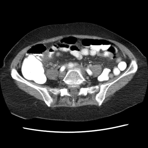 File:Acute appendicitis (Radiopaedia 52672-58589 Axial C+ arterial phase 12).jpg